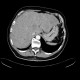 Liver metastases: CT - Computed tomography